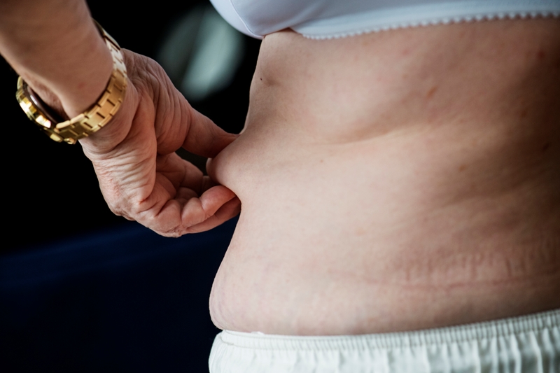 Hasplasztika vs. zsírleszívás: Mi a különbség?